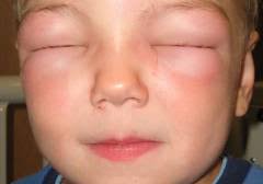 مداخله برای سندروم نفروتیک ایدیوپاتیک مقاوم به استروئید در کودکان